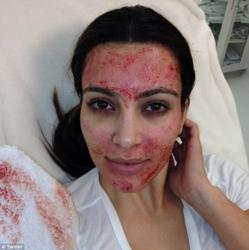 Kim K gets Vampire Facial, an age-defying facelift using her blood peculiarmagazine
